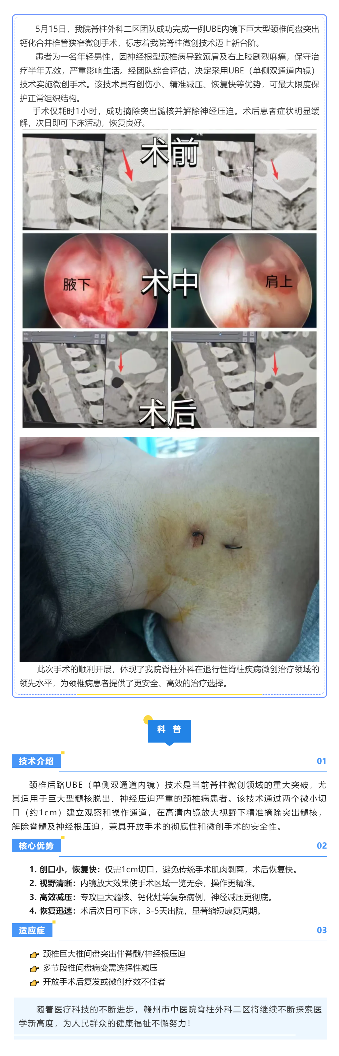 當天手術&rarr;次日下床：UBE技術讓頸椎病康復快3倍！.png